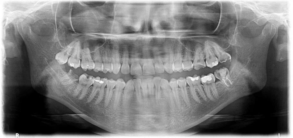 Снимок зубов видное. Панорамный снимок зубов. Воспаление нерва в зубе рентген.