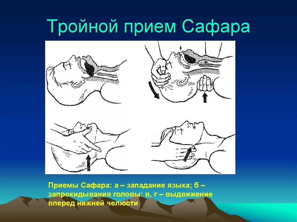 Тройной прием алгоритм. Западение языка прием Сафара. Сердечно легочная реанимация тройной прием Сафара.