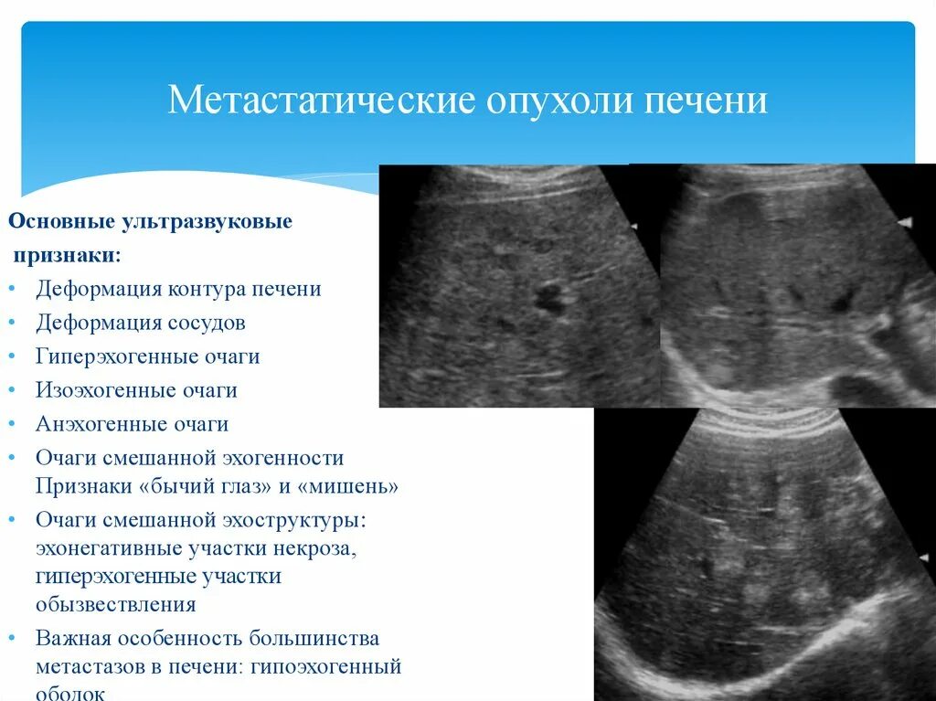 Признаки отека печени. Образования печени на УЗИ. Объемные образования печени.