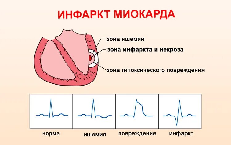 Зона ишемии. Форма сердца при инфаркте миокарда. Зоны инфаркта миокарда рисунок. Классификация инфаркта миокарда крупноочаговый. Острый инфаркт миокарда сердце.