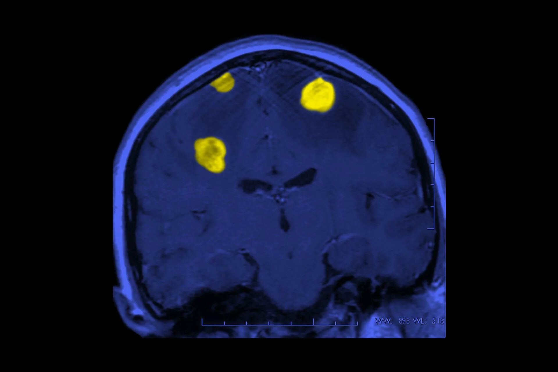 Brain 254. Опухоль головного мозга снимок. Просовидные метастазы головного мозга. Меланома на кт головного мозга.