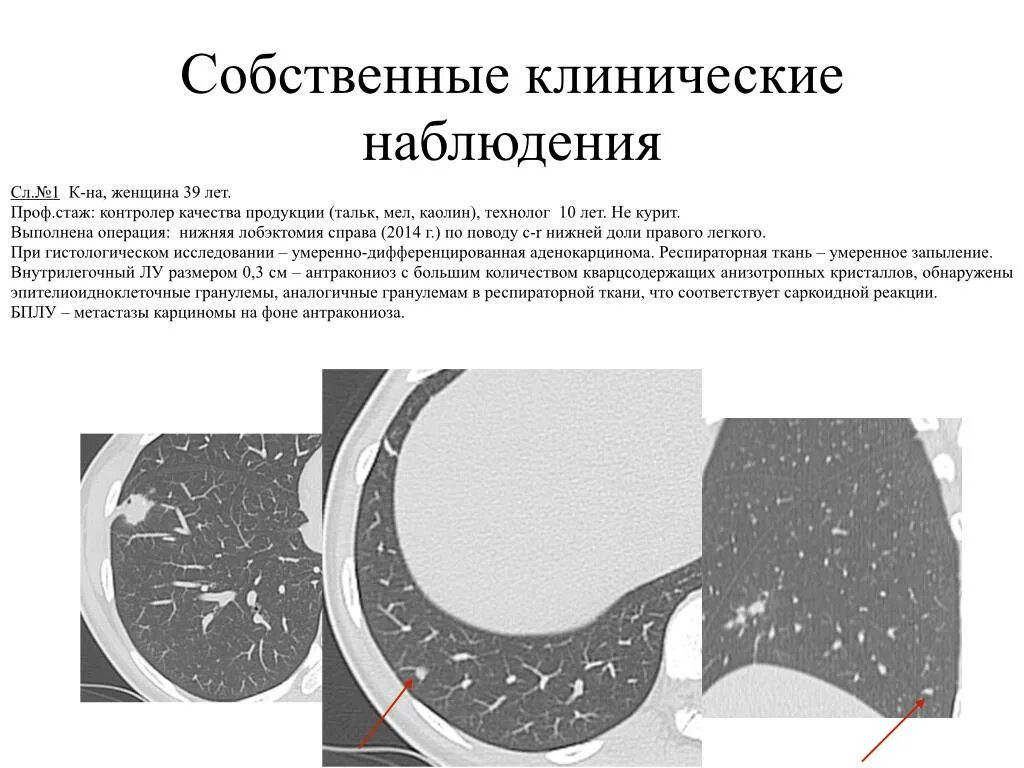 Внутрилегочные лимфоузлы на кт. Внутрилегочные лимфоузлы. Внутрилегочные лимфоузлы. Внутрилегочные лимфоузлы. Внутрилегочные лимфоузлы.