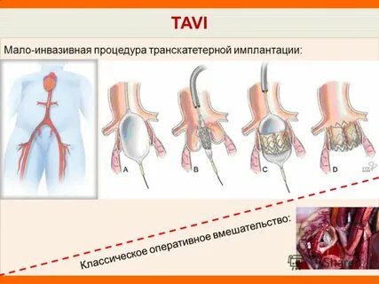 Операции на аортальном клапане