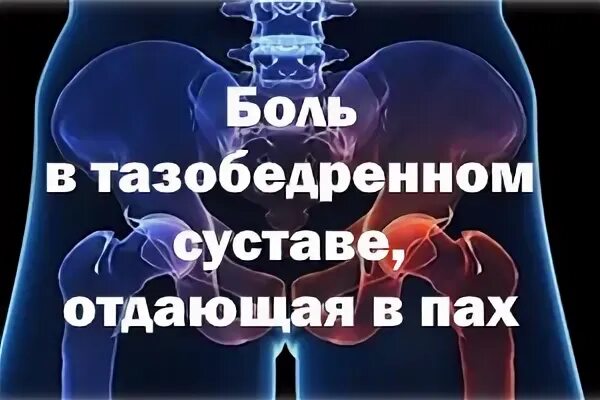 Отдает в пах у мужчин причины. Боль в тазобедренном суставе отдающая. Боль в тазобедренном суставе отдающая в пах у женщин. Бедренный сустав боль отдает в пах. Боль в тазобедренном суставе отдающая в ногу.