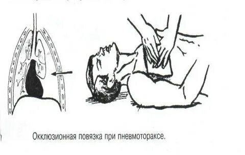 Пневмоторакс первая помощь