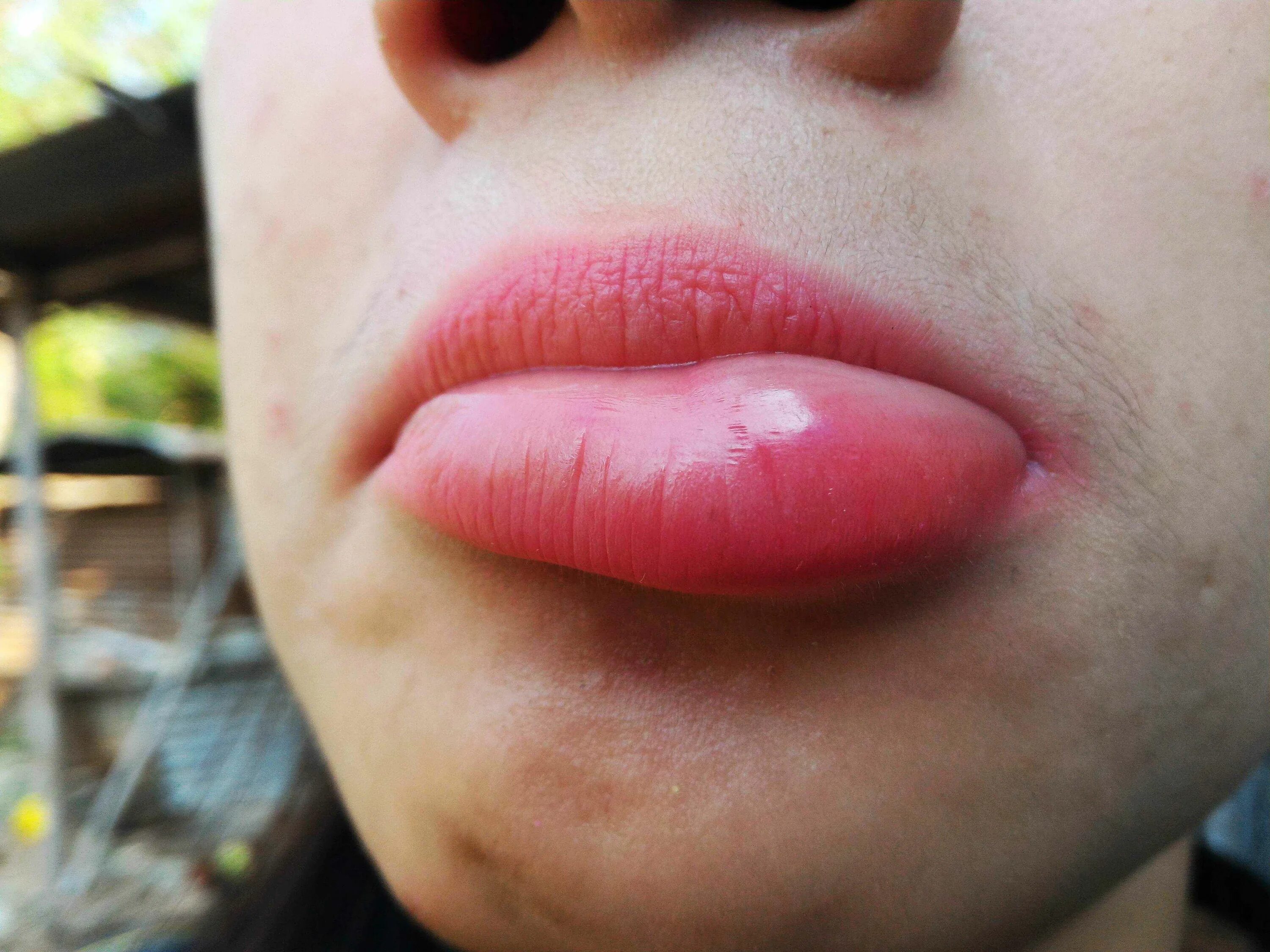 Home Remedies: Stung by a bee - Mayo Clinic News Network
