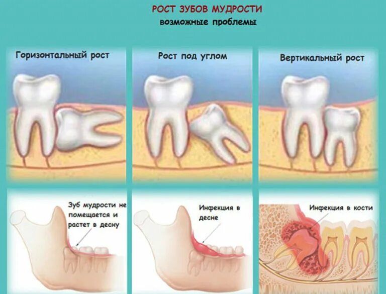 Как долго растут зубы мудрости