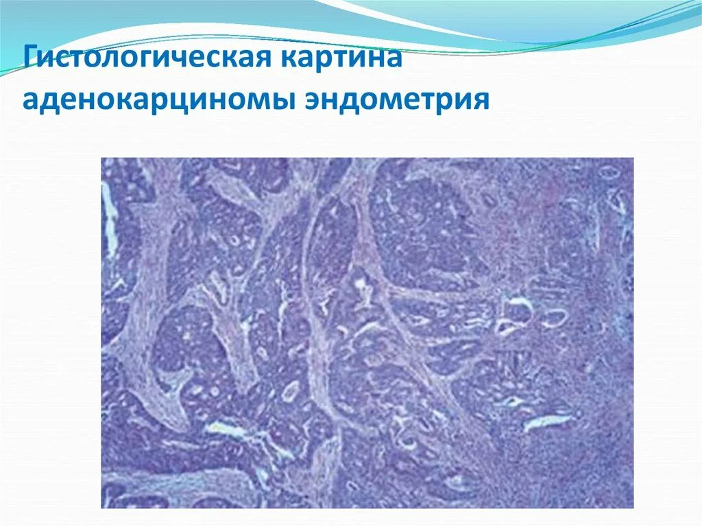 Слизеобразующая аденокарцинома гистология. Эндометриоидная аденокарцинома гистология. Эндометриоидная аденокарцинома матки гистология. Низкодифференцированная аденокарцинома эндометрия гистология.