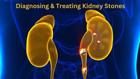 How To Diagnose & Treat Kidney Stones - YouTube