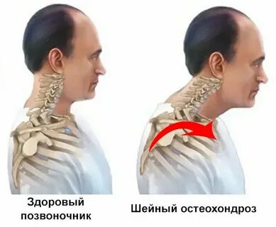 Что лучше при шейном остеохондрозе