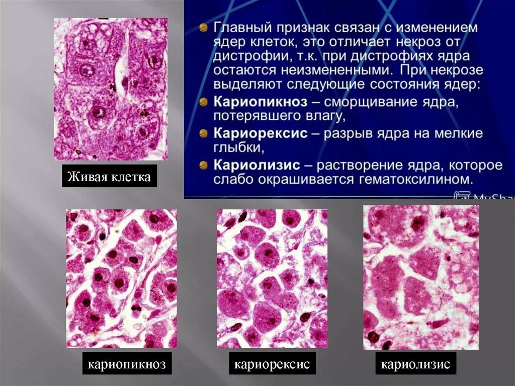 Растворение ядрышка. Кариорексис кариолизис. Некроз кариопикноз. Апоптоз кариорексис кариопикноз.