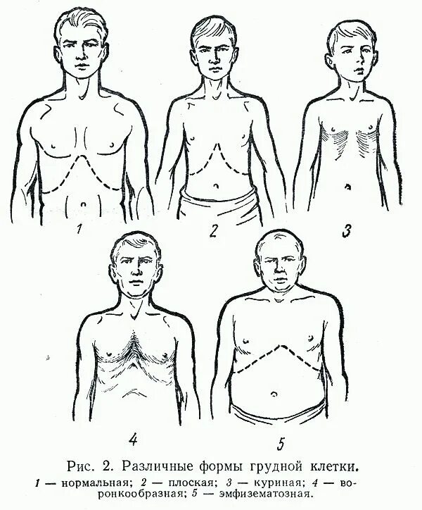 Грудная клетка у ребенка норма. Врожденные деформации грудной клетки килевидная грудь. Врожденная килевидная деформация грудной клетки. Патологические формы грудной клетки эмфизематозная. Бочкообразная форма грудной клетки у грудничка.