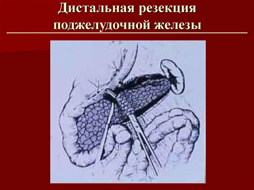 Делают ли операцию на поджелудочную. Дистальная (левосторонняя) резекция поджелудочной железы. Резекция поджелудочной железы схема. Резекция головки поджелудочной железы схема. Дистальная резекция поджелудочной железы этапы операции.