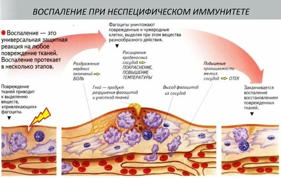 Воспаление фагоцитоз лейкоцит безразличный раздражитель микроворсинка. Воспаление при неспецифическом иммунитете\. Воспалительная реакция. Воспалительный процесс в организме.