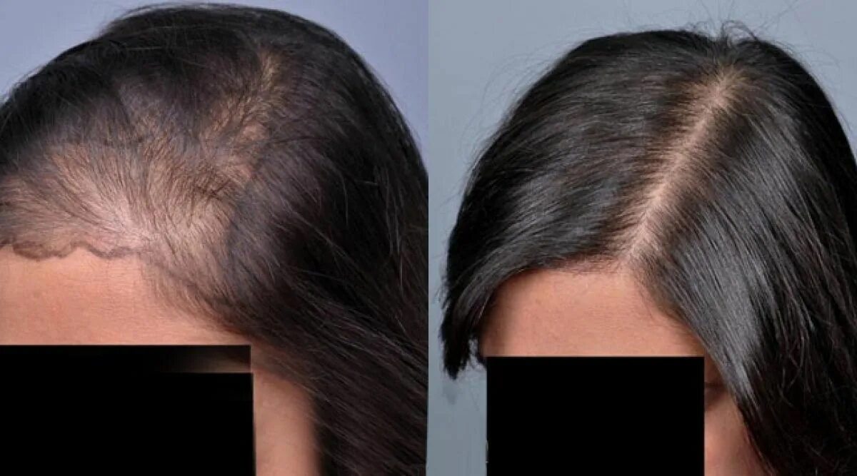 Система волос. Мезотерапия для волос от выпадения. Алопеция у женщин лечение отзывы