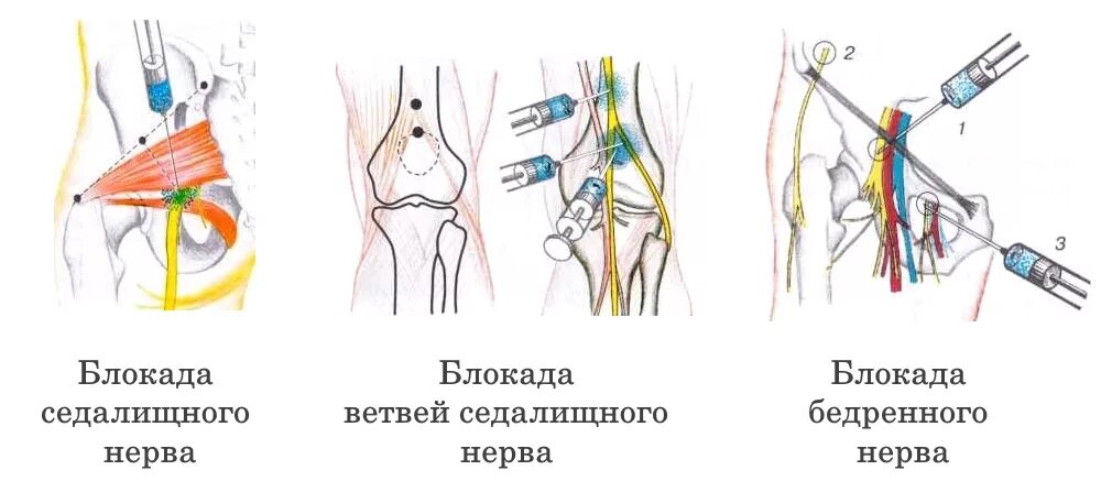 Какие уколы от защемления нерва. Блокада седалищного нерва техника выполнения. технику блокады седалищного нерва. точка блокады седалищного нерва на бедре. техника блокады при невралгии седалищного нерва.