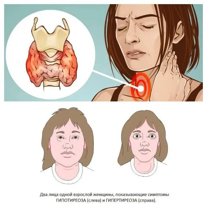 Какие признаки щитовидной железы у женщин. Щитов железа симптомы заболевания. Щитовидная железа симптомы заболевания. Щетавитки железа симптоми. Синдромы заболеваний щитовидной железы.