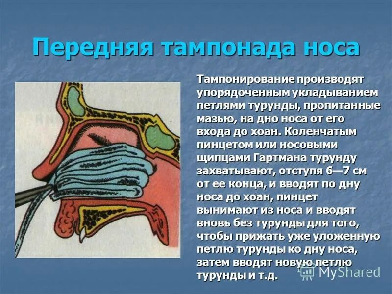 Тампонада полости носа алгоритм. Тампонада при носовом кровотечении алгоритм. Передняя тампонада носа. Передняя и задняя тампонада носа.