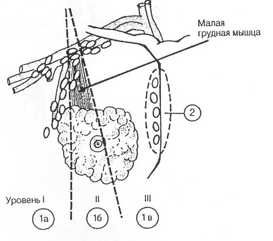 После операции молочной железы и лимфоузлов. Уровни лимфоузлов молочной железы. Лимфоузлы 3 уровня молочной железы. Молочная железа регионарные лимфатические узлы. Лимфоотток молочной железы схема.