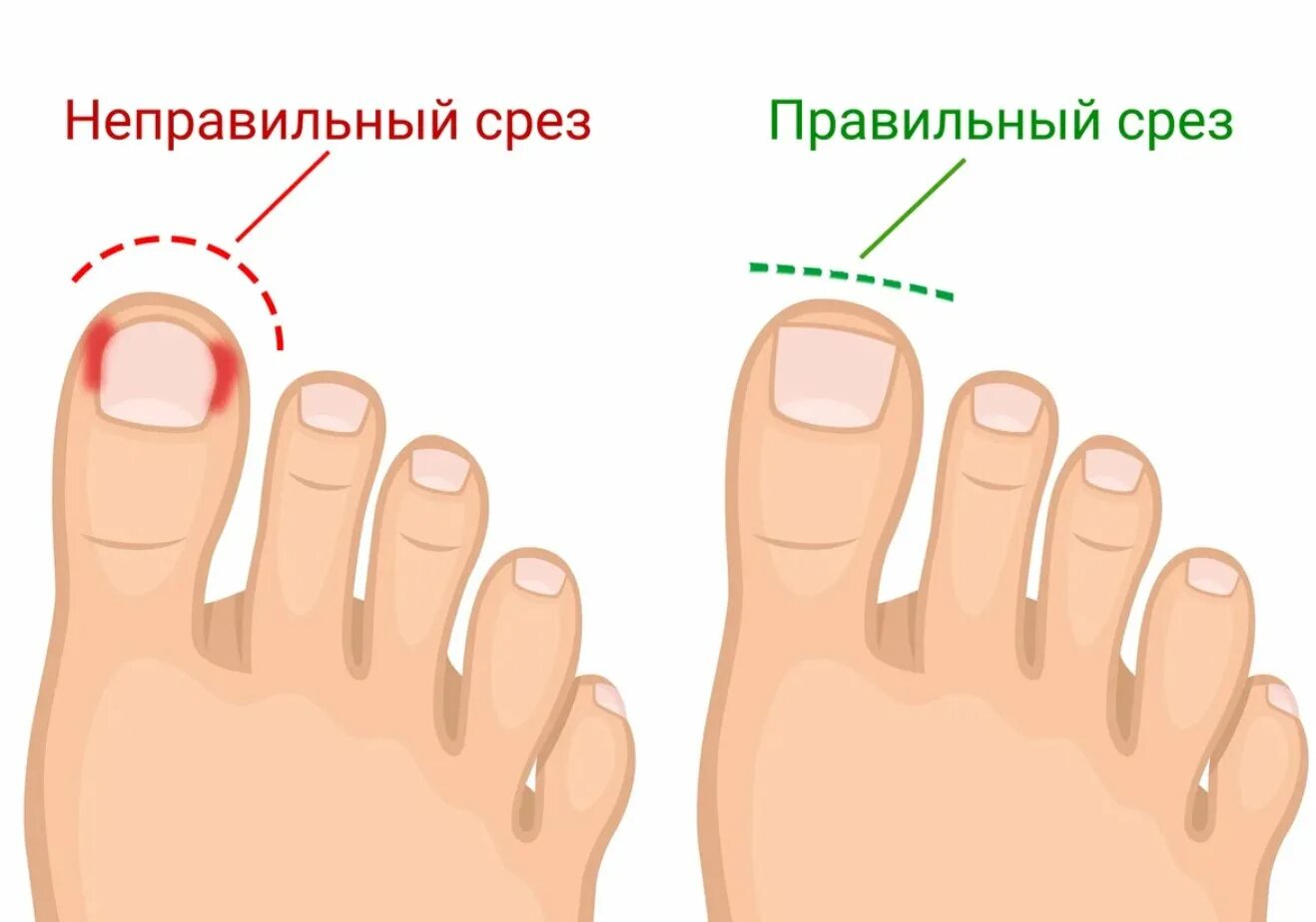 Как подстригать ногти на большом пальце. Как правильно стричь ногти на ногах. кпк правильно стрич ногти нп ногах. как правильно подстригатьногтина ногвх. правильная форма ногтей на ногах.