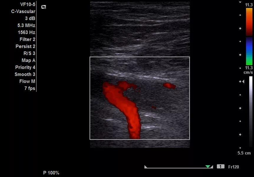 Тромбоз бедренной артерии УЗИ. Тромбоз подколенной вены на УЗИ. Тромб в правом