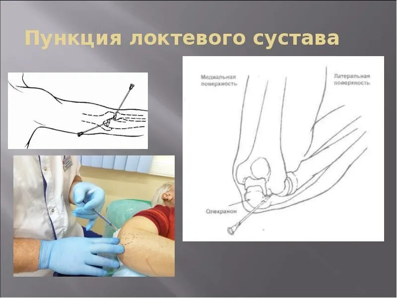 Пункция сустава техника выполнения. Пункция локтевого сустава топографическая анатомия. Пункция бурсита локтевого. Точки пункции локтевого сустава показания. Точки пункции локтевого сустава топографическая анатомия.