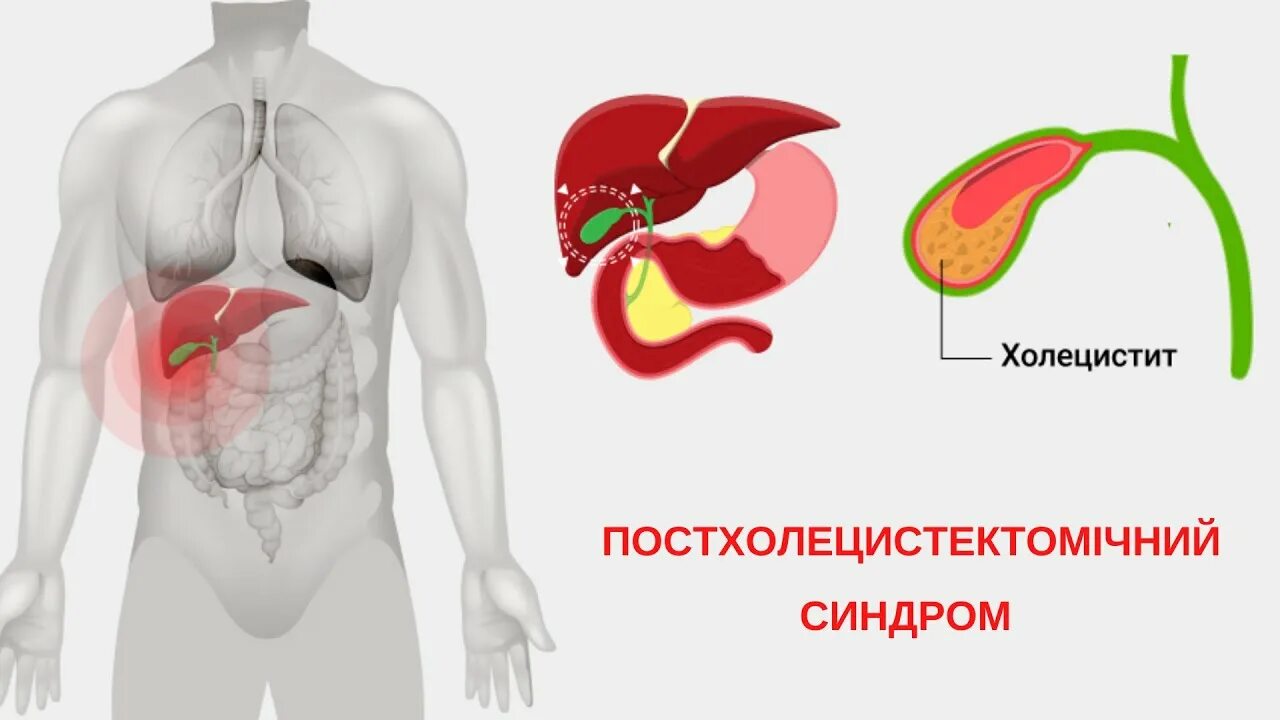 Воспаление желчного пузыря лечение у мужчин