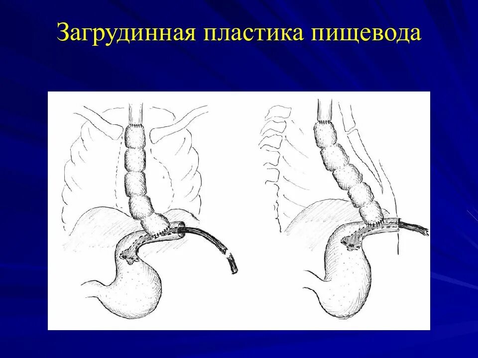 Загрудинная пластика пищевода. Операция пластики пищевода. Пластика пищевода кишкой.