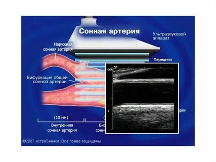 Узи сонных артерий