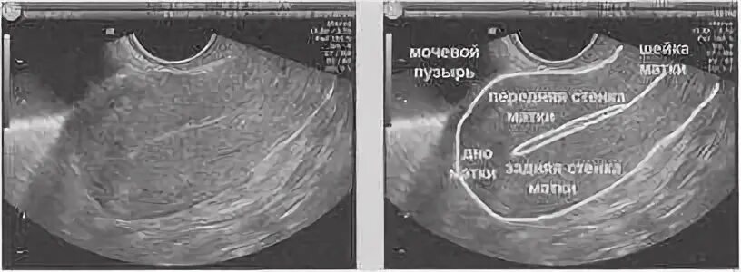 Поперечный срез матки УЗИ. УЗИ матки показатели нормы. Ультразвуковое исследование матки УЗИ норма. Сагиттальный срез матки на УЗИ. Узи при миоме матки на какой день