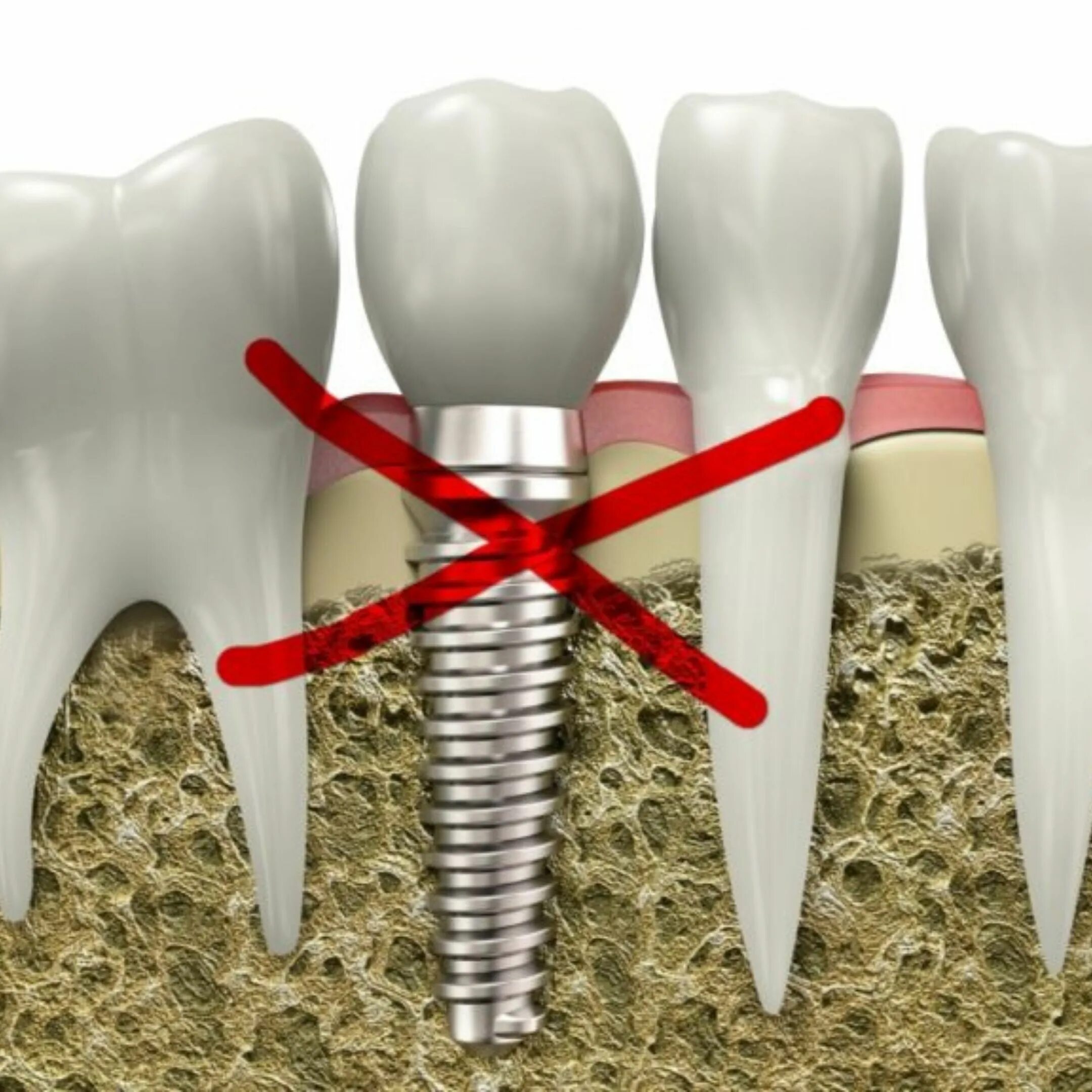 Зубной имплантат. Имплантаты в стоматологии.
