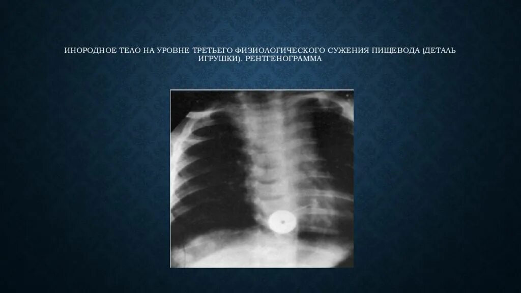 Тело пищевода. Инородные тела пищевода. Инородные тела пищевода у детей. Инородное тело пищевода рентген. Физиологические сужения пищевода рентгенограмма.