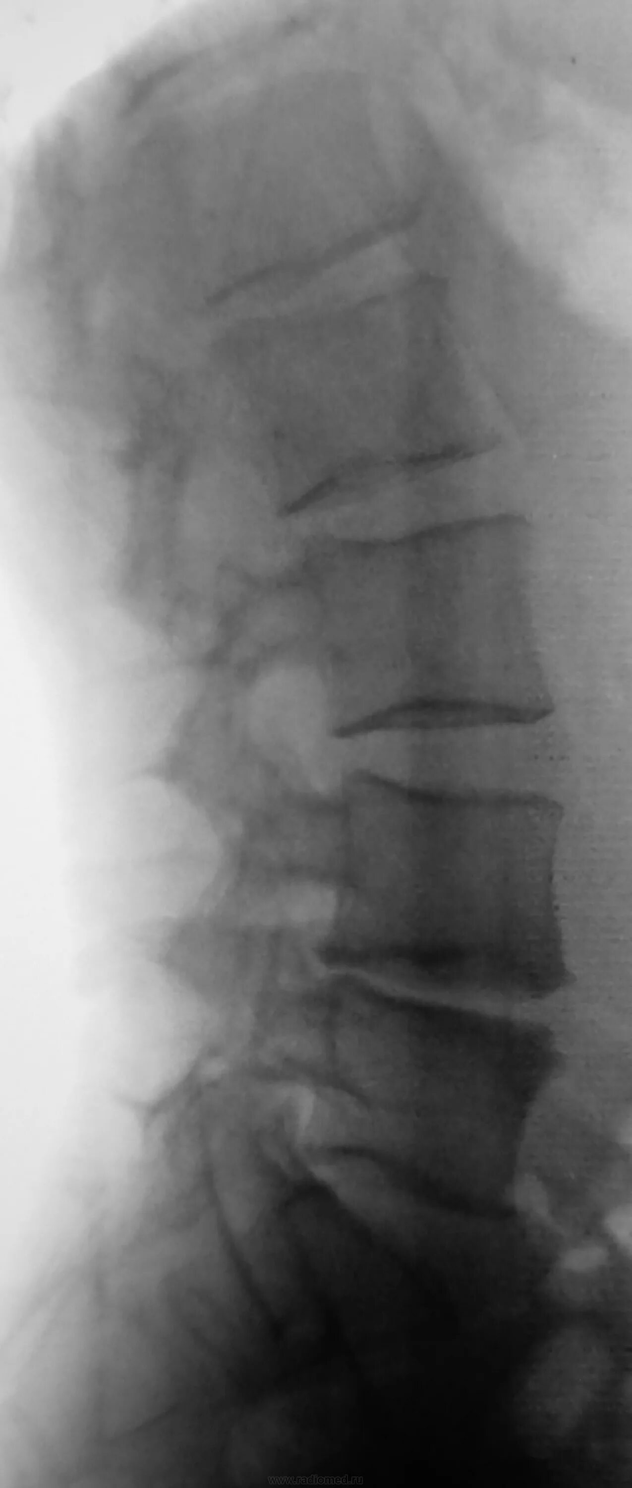 Рентгенография поясничного отдела позвоночника подготовка. Гребешковая линия рентген поясничного отдела. Рентген поясничного отдела l1. Латеролистез позвонка рентген. Поясничное ребро рентген.