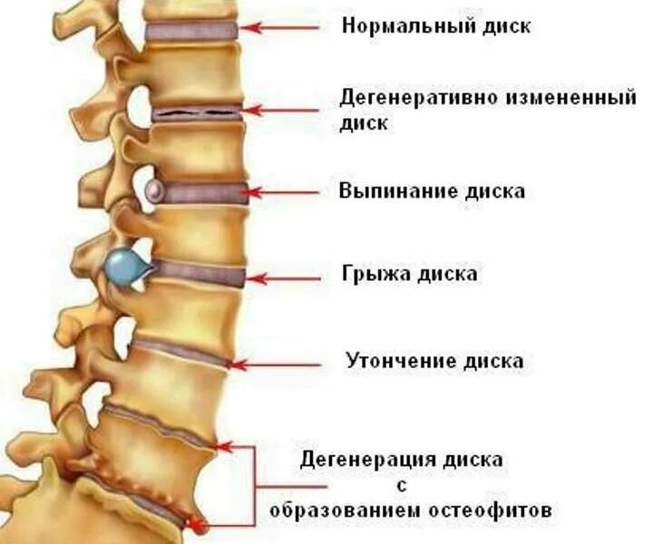 Спондилез l4 s1. Спондилёз поясничного отдела позвоночника что это такое. Межпозвонковый спондилоартроз с7-th1. Остеохондроз спондилоартроз поясничного отдела позвоночника. Спондилоартроз межпозвонковых дисков поясничного отдела.