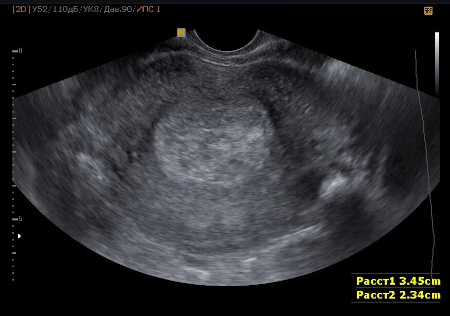 Маточная беременность на ранних сроках. УЗИ беременности на ранних сроках. Маточная беременность УЗИ.
