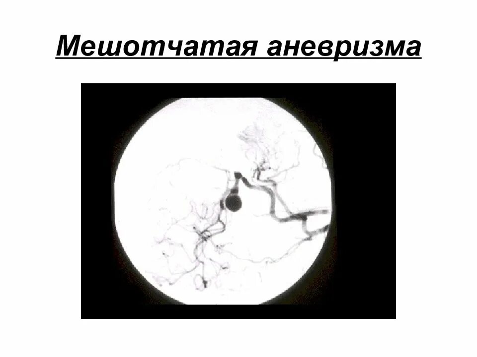 Мешотчатая аневризма внутренней. Мешотчатая аневризма сосудов головного. мешотчатая аневризма сосудов головного мозга. фузиформная и мешотчатая аневризма.