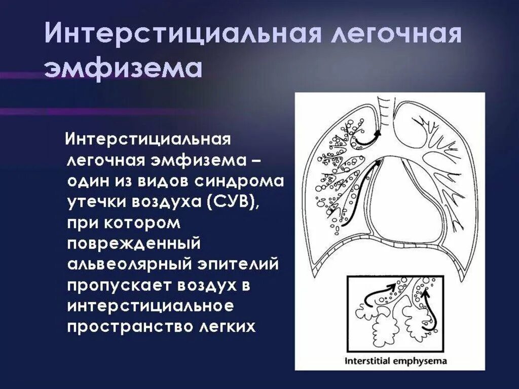 Интерстициальная эмфизема. Интерстициальная эмфизема легких. Альвеолярная эмфизема.