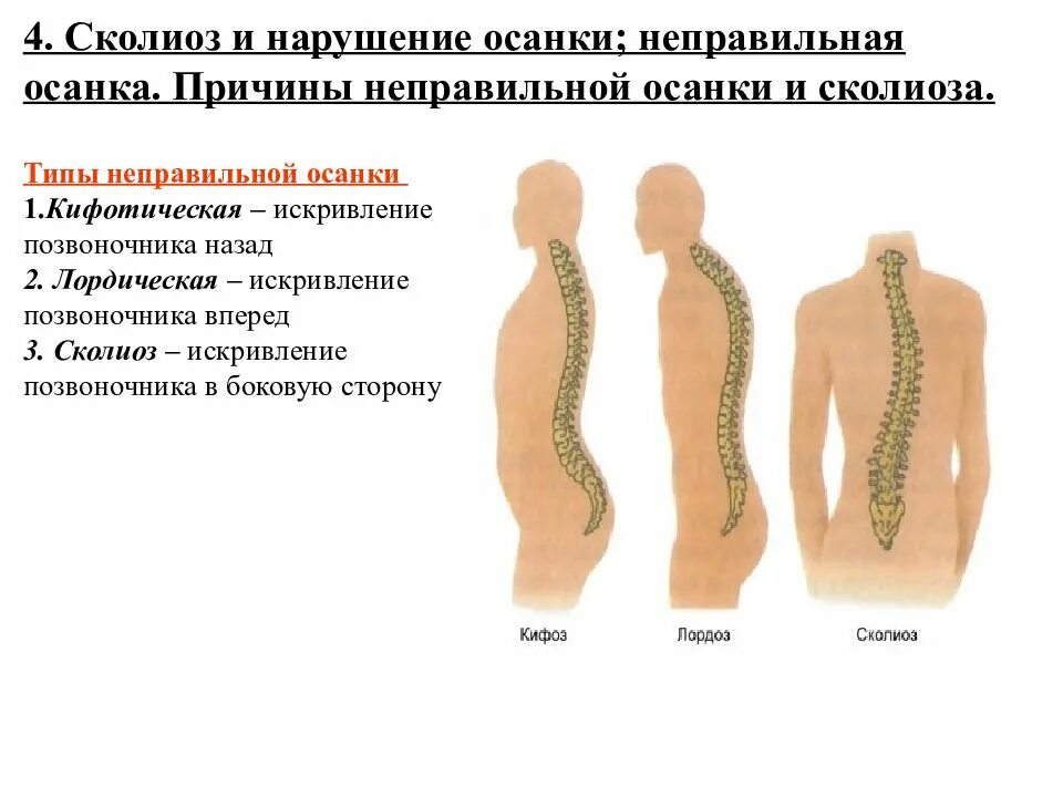 Изменение формы позвоночника. Сколиотическиц Тип осанки. Искривление позвоночника кифоз и лордоз. Сколиоз вид сбоку. Нарушение осанки и деформация позвоночника.