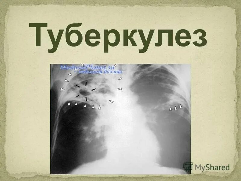 Туберкулез презентация. Туберкулёз призентация. Туберкулёз презинтация. Туберкулез слайд