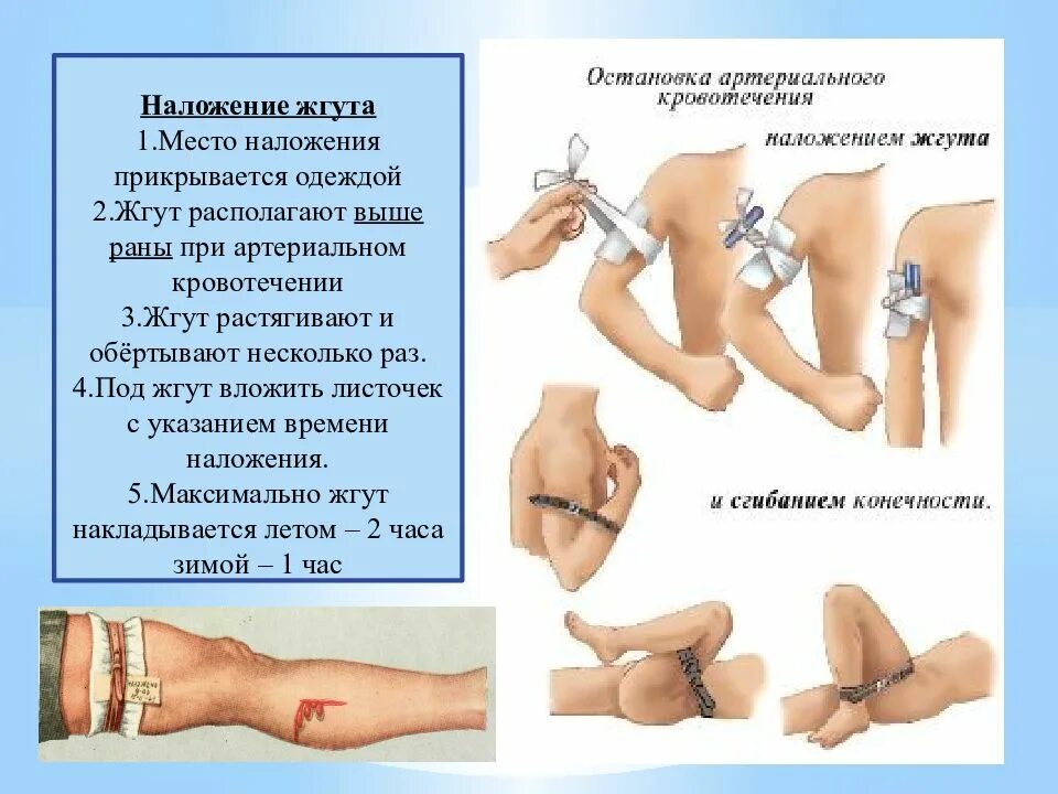 Наложение жгута при кровотечениях. Наложение жгута при артериальном кровотечении. Наложение артериального жгута при артериальном кровотечении. При каком виде кровотечения необходимо наложить жгут