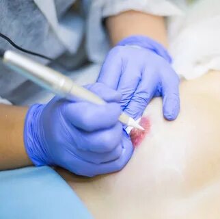 Images ЛАЗЕРНАЯ ЭПИЛЯЦИЯ АРЕОЛЫ