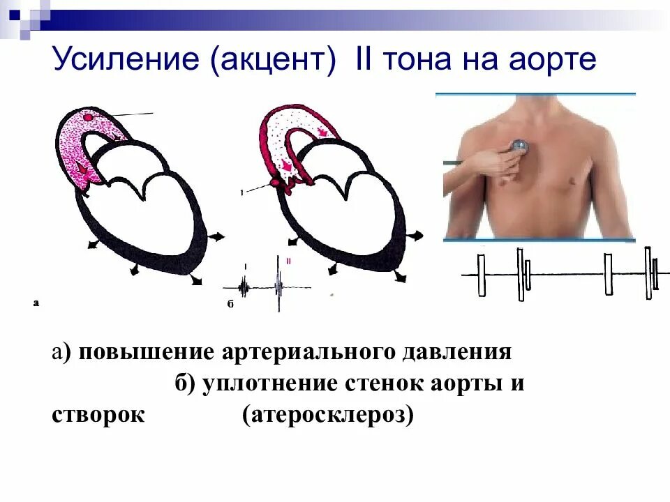 Ослабление 2 тона над аортой. Акцент 2 тона на аорте при. Усиление второго тона на аорте. Ослабление тонов сердца в норме и при патологии. Ослабление первого тона на верхушке.