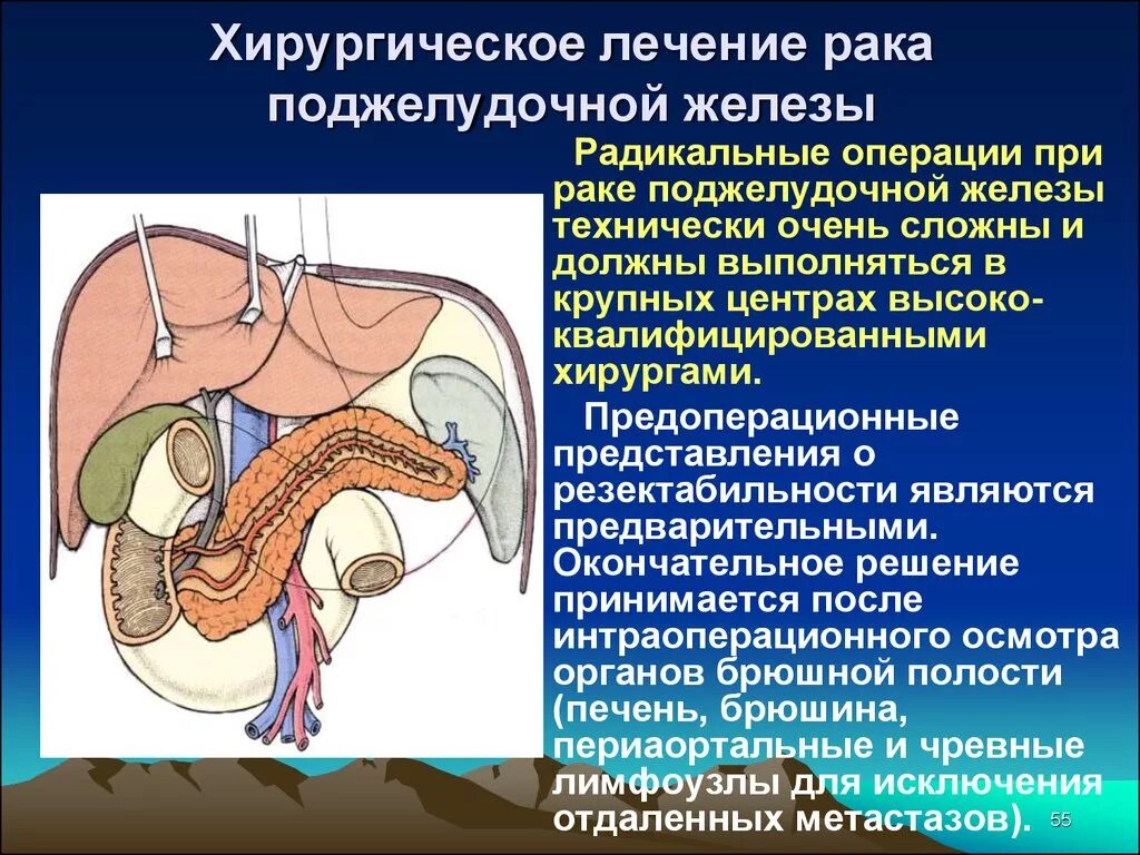 Операция Рамс поджелудочная железа. Операция на желудок и поджелудочную железу. Онкология поджелудочной железы. Поджелудочной железы (опухоли и панкреатит);.