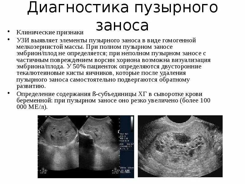 Узи после лечения. Пузырный занос этиология патогенез. УЗИ диагностика пузырного заноса. Клинические симптомы пузырного заноса. Клинические проявления пузырного заноса.