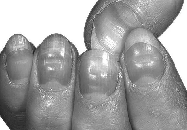 Онихолизис и онихомикоз. Что означает вмятины на ногтях рук. Маленькие ямки на ногтях. Поперечные вмятины на ногтях. Травматичный онихолизис.