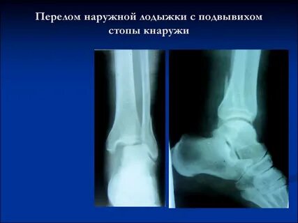 Наружная лодыжка голени