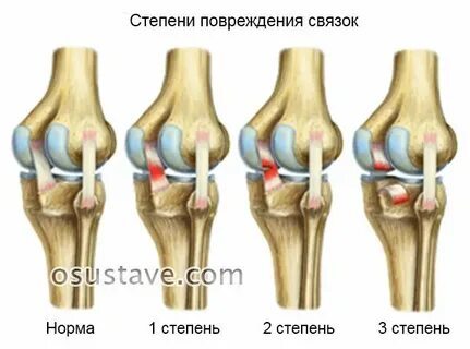 Растяжение передней крестообразной связки коленного