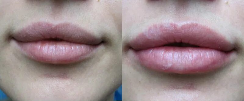 Увлажнение губ до и после. Губы гиалуроновой кислотой. Увлажнение губ гиалуроновой кислотой. Гиалуроновый гель для губ. Увлажненные губы до и после.