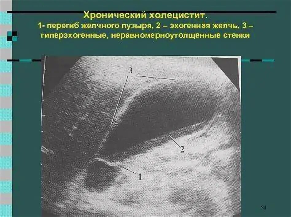 Таблетки от холецистита желчного пузыря. Болотовский врач педиатр. Таблетки от холецистита желчного пузыря. Таблетки от холецистита желчного пузыря. Желчегонные препараты при холецистите.