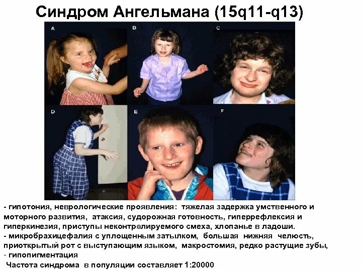 Что такое айси синдром у детей фото. Синдром ангельмана симптомы. синдром ангельмана тип наследования. синдром ангельмана причины.